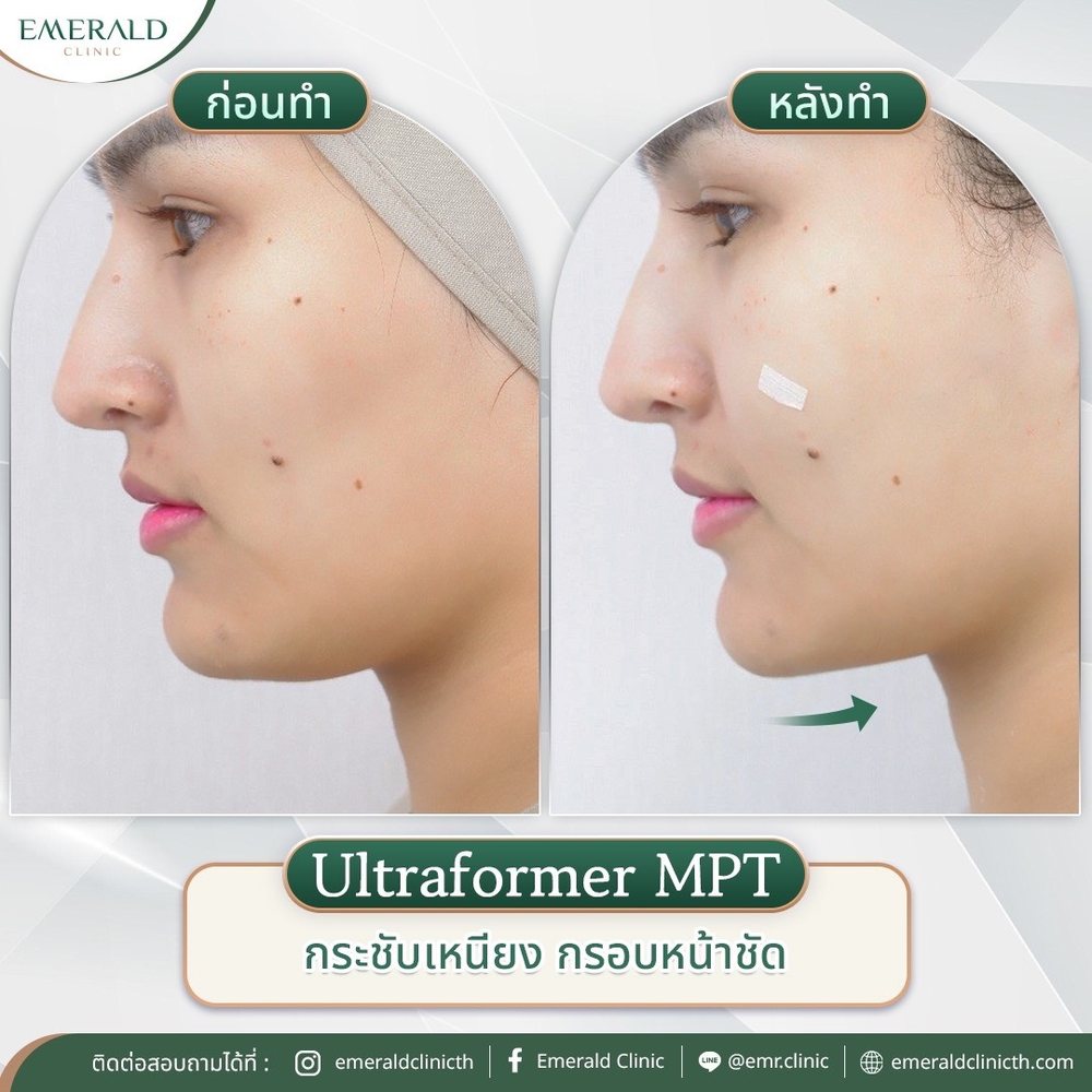 Ultraformer MPT, before and after