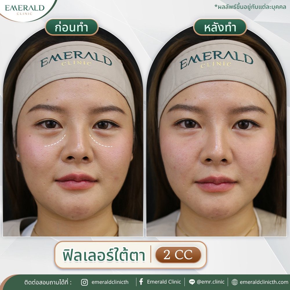 Under-eye filler, before and after