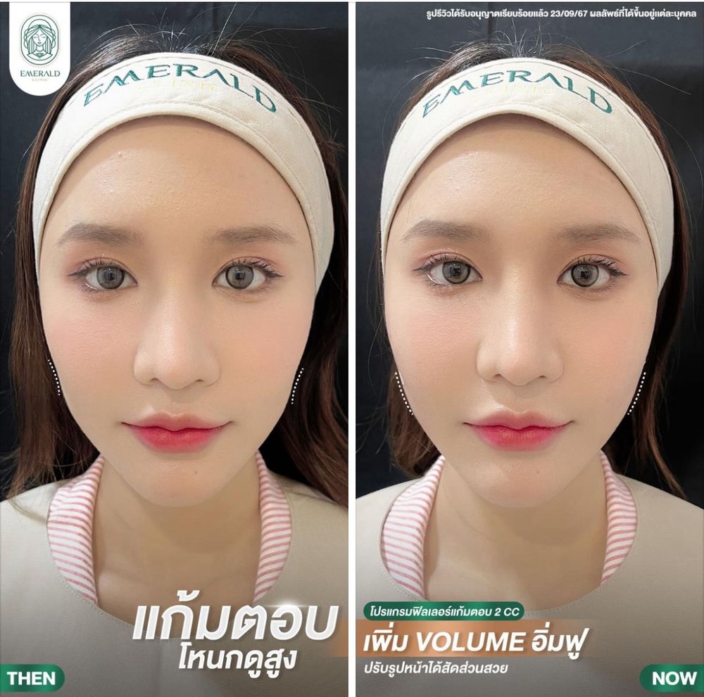 Cheek filler, before and after