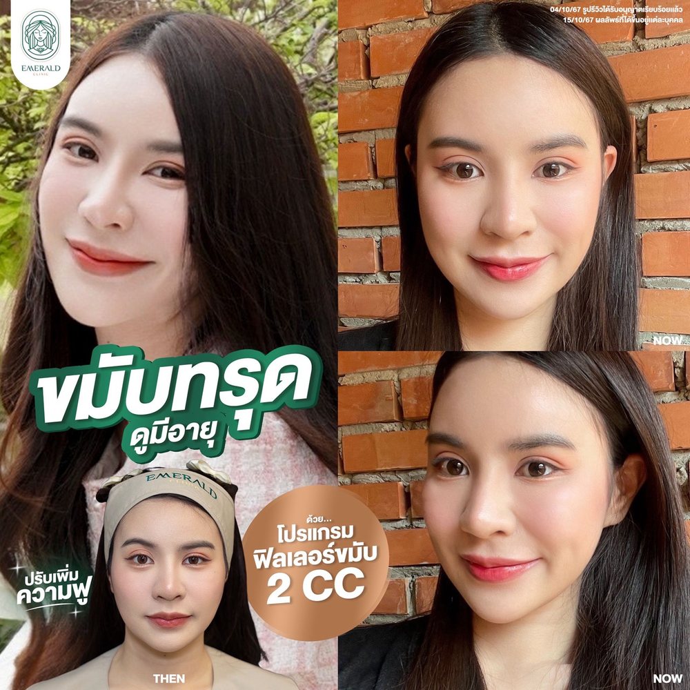 Temple filler, before and after