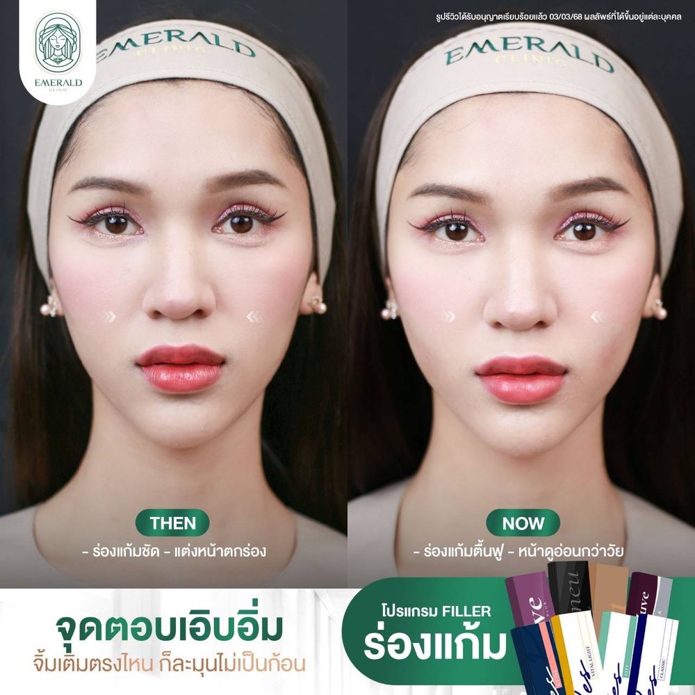 Nasolabial fold filler, before and after