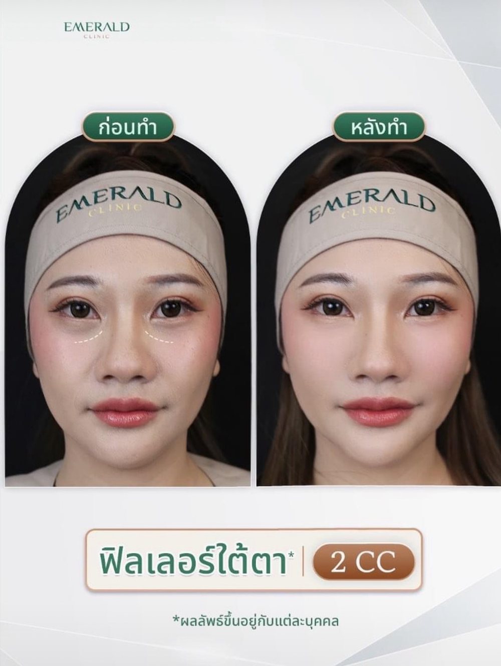 Under-eye filler, before and after